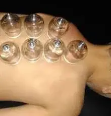 A row of cupping therapy glasses applied along someone's upper back and shoulder.