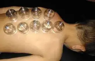 A row of cupping therapy glasses applied along someone's upper back and shoulder.