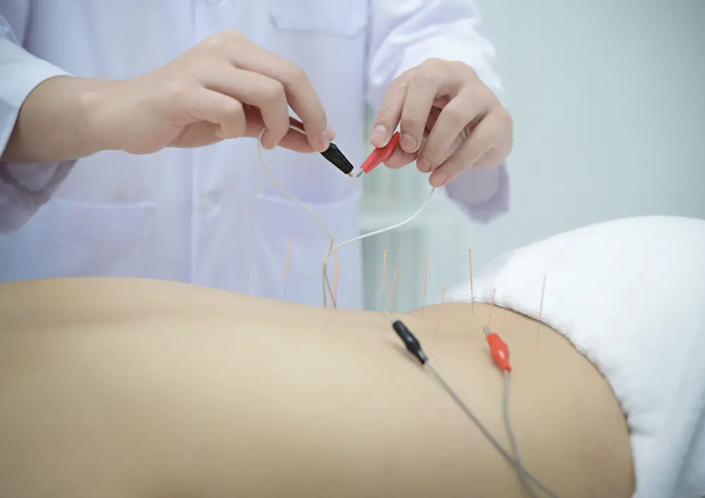 A practitioner clips the leads of an electro-acupuncture device onto fine needles placed along a person's lower back.