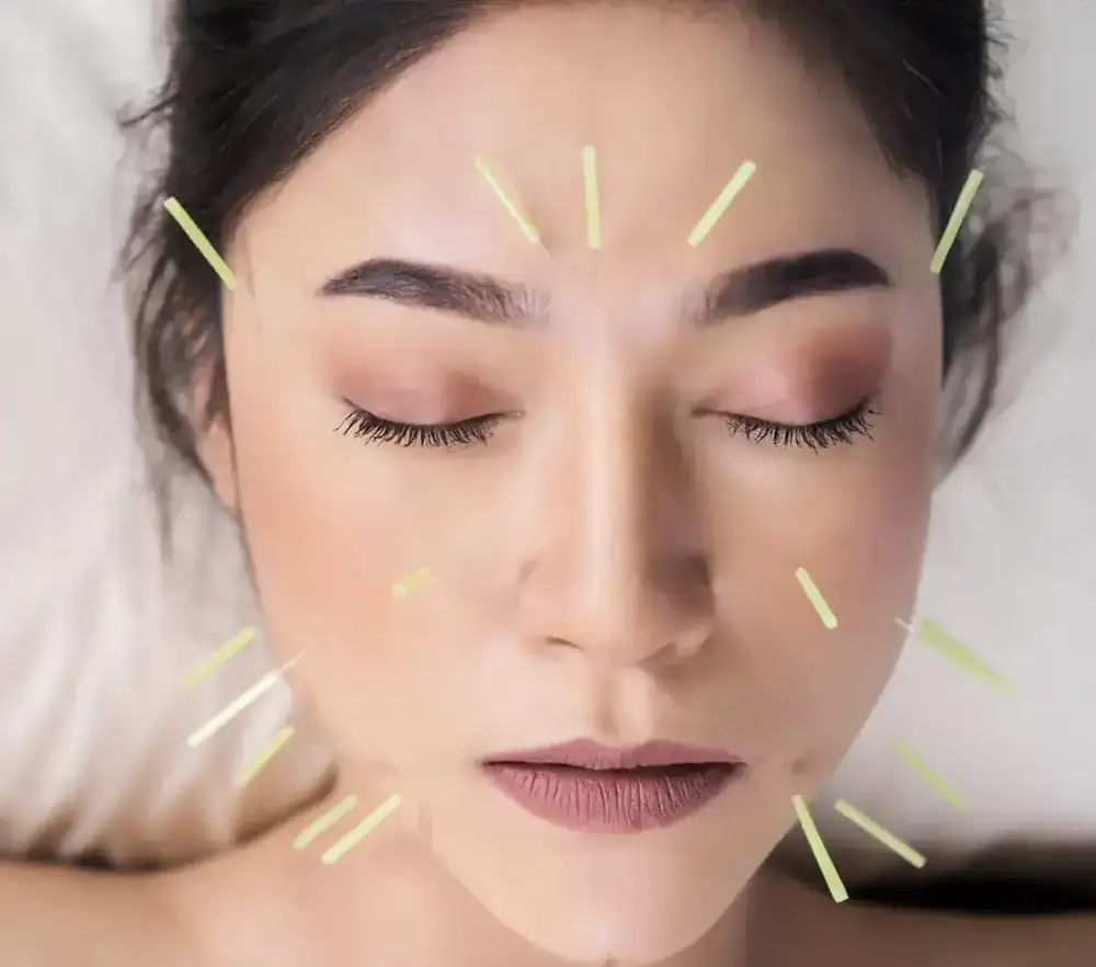 A woman resting with her eyes closed during facial acupuncture, fine needles placed on her forehead, cheeks and jaw.