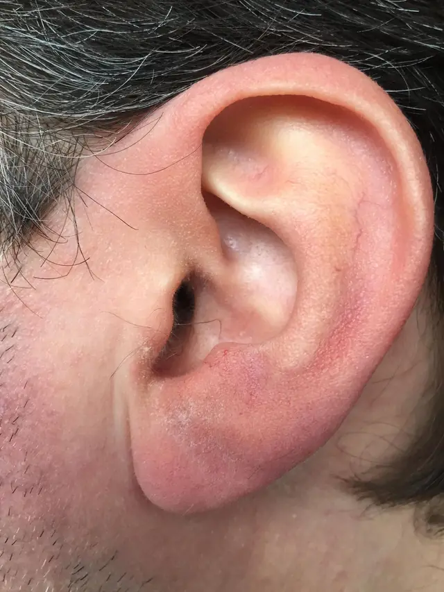 Example photo: a left ear, photographed close up with a flash, no shadows.