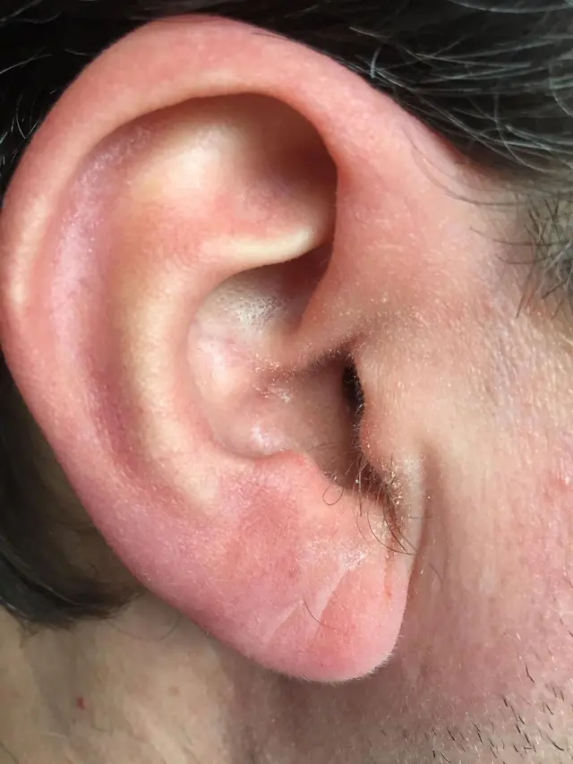 Example photo: a right ear, photographed close up with a flash, no shadows.