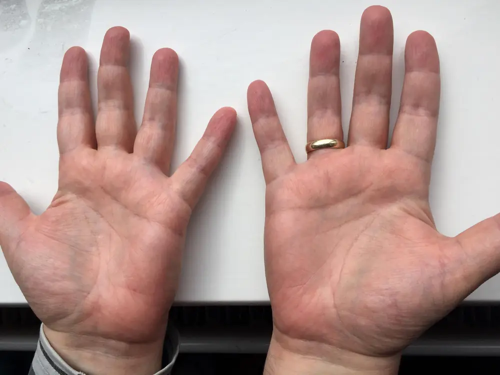Example photo: the insides of both palms, side by side, including a little of the wrists.