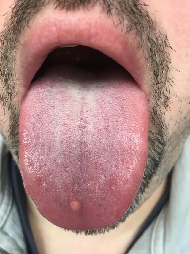 Example photo: a tongue stuck out fully, lit evenly with a flash.