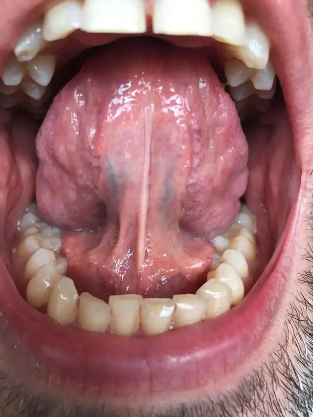 Example photo: the underside of the tongue, with the tongue tip raised to the upper gum ridge.