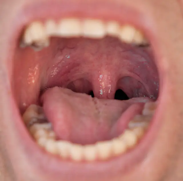 Example photo: an open mouth showing the back of the tongue and the uvula.